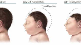 Zika and Microcephaly